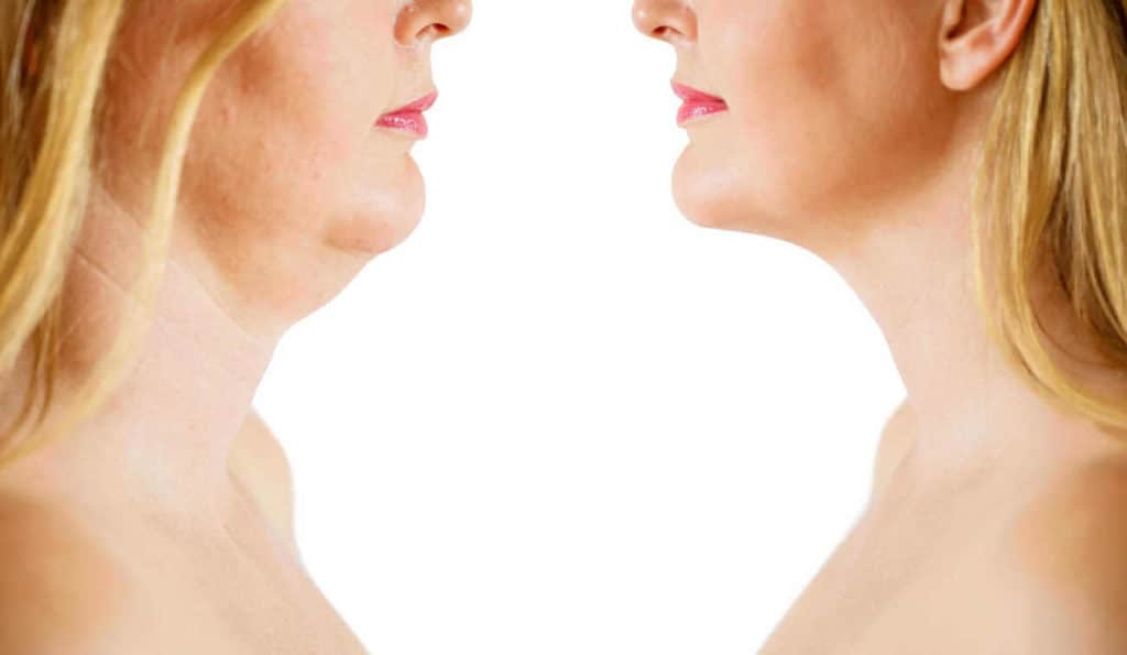 Double Chin treatment Prestwich before and after results