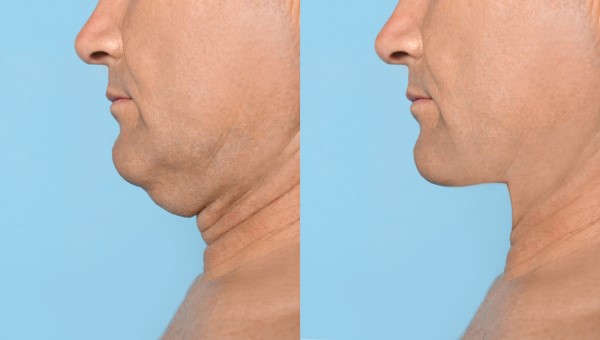 Which Non-Surgical Treatments Work Best for Jowls and Loose Skin Prestwich?