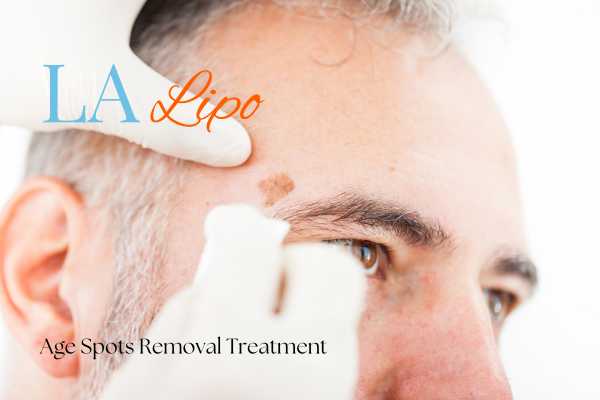 What Are the Most Effective Treatments for Age Spots Prestwich?