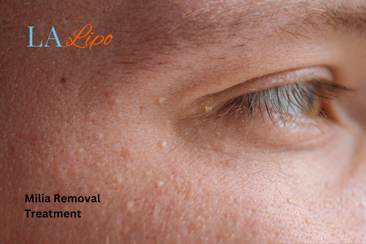 Cryopen Milia Removal: Is It the Easiest and Safest Option Prestwich?