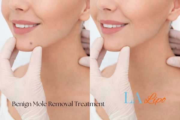 woman's before and after mole removal Prestwich results