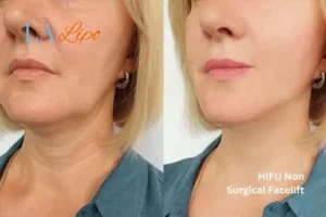 hi-fu for wrinkles Prestwich before and after results