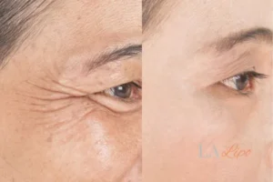 Before and after results of woman - HI-fu wrinkles reduction treatment Prestwich