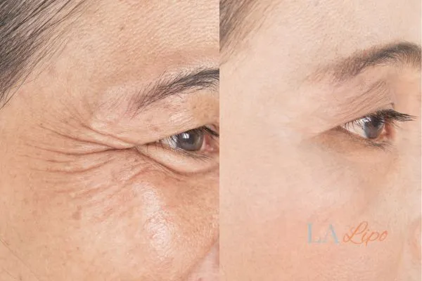 Before and after results of woman - HI-fu wrinkles reduction treatment Prestwich