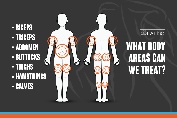 Graphic to show areas you can have LA-EMS Body Sculpting Prestwich treatment.
