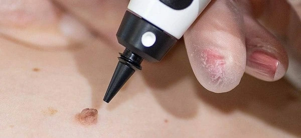 skin tag removal using cryopen Prestwich