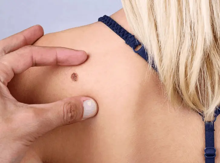 woman having mole removal Prestwich consultation before treatment.