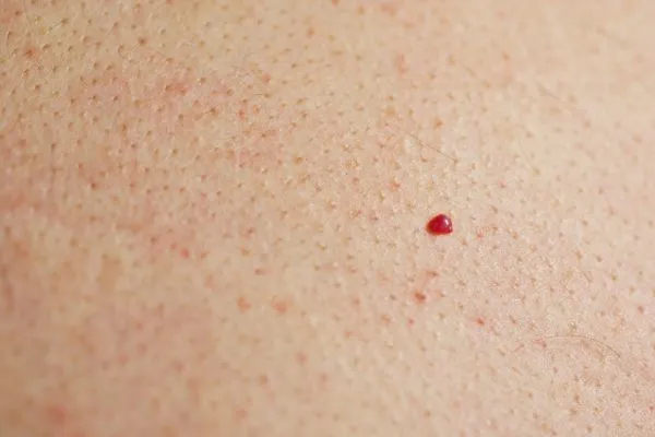 close up of a cherry angioma Prestwich