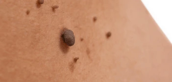 image of a skin tag Prestwich