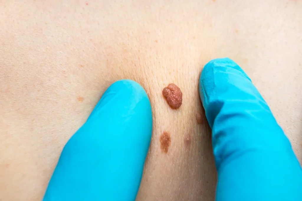 Consultant examining a skin tag Prestwich