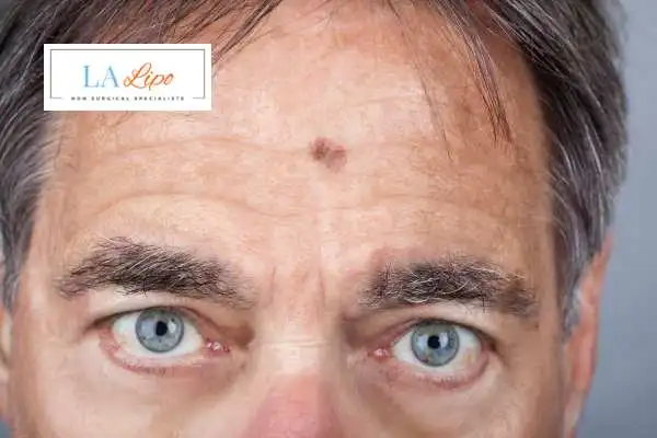 Solar Lentigo Removal Prestwich image of man with mark on his forehead