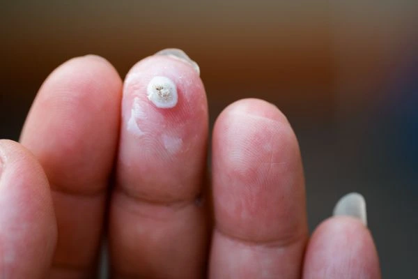 wart on person finger - cryotherapy to treat from LA LIPO Prestwich