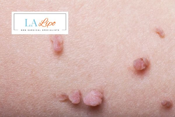 Does cryopen skin tag removal Prestwich hurt? Find out now call our team today!