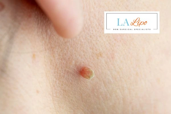 Book skin tag removal Prestwich today speak to our team now!