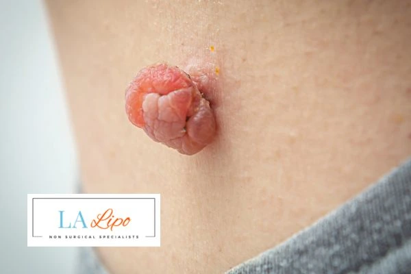 Interested in skin tag removal Prestwich? Concerned about the pain? Find out more today!