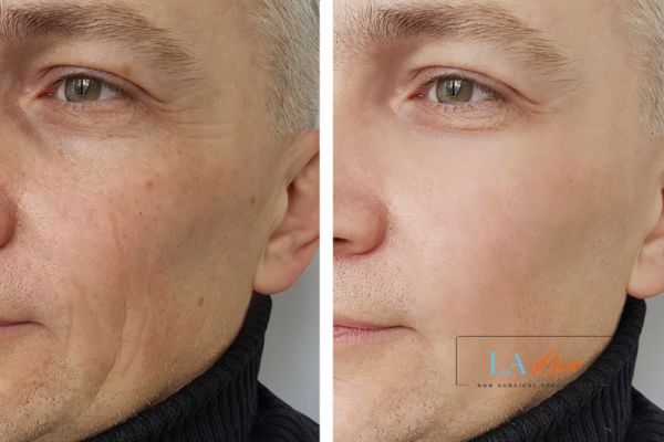 See the amazing results of Morpheus8 Treatment Prestwich!