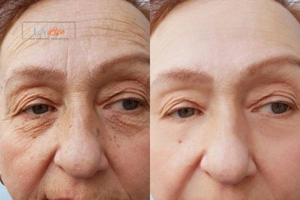 The powerful benefits of Morpheus8 Treatment Prestwich - Call Our team today!