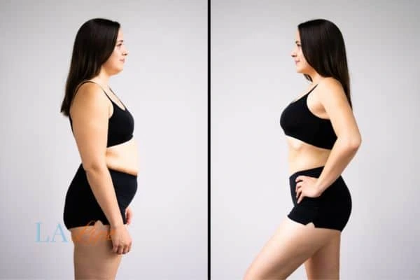 Picture of womans before and after using LA-EMS body sculpting to improve her core strength Prestwich