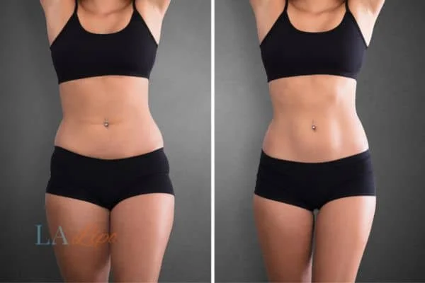 before and after results of non-surgical treatment to help a woman's body image and mental health Prestwich