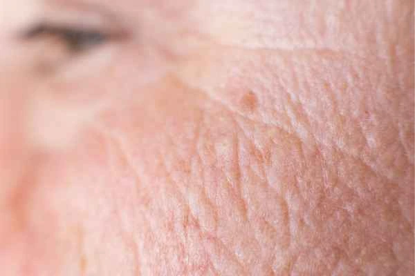 close up picture of a woman's face showing an age spot Prestwich
