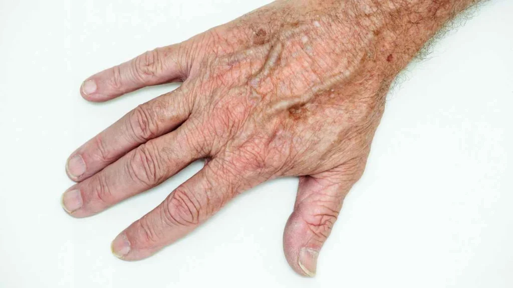 Male hand showing age spot Prestwich