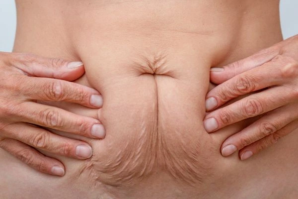 Image of a woman's stomach with loose skin - example of skin tightening Prestwich options