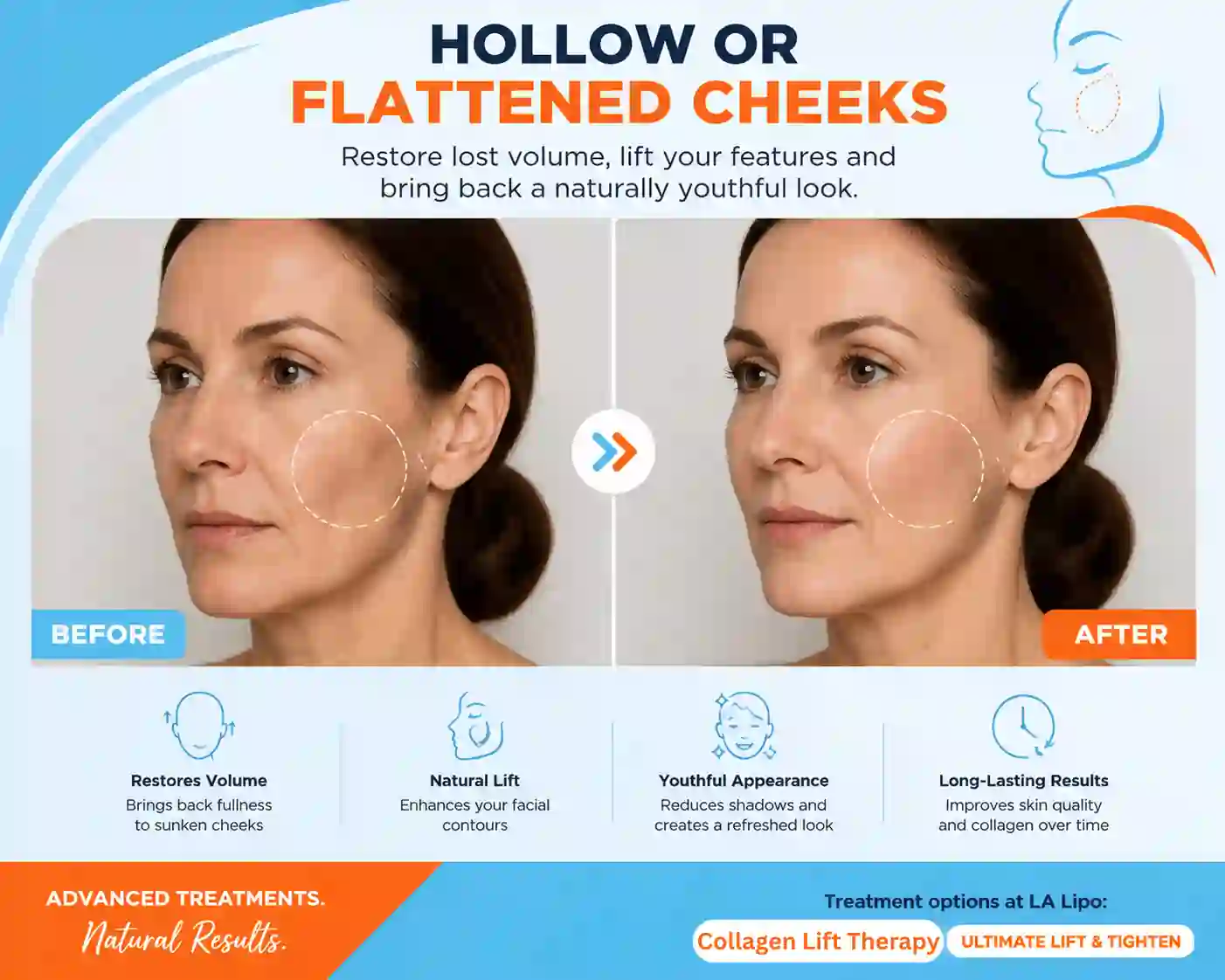 Sign #4: Hollow or Flattened Cheeks Prestwich