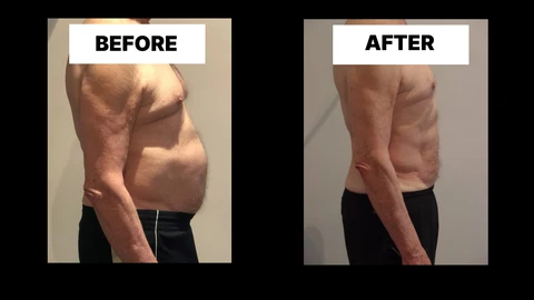 What Symptoms Can Diastasis Recti Cause in Men? Weak Core, Back Pain and Poor Posture Prestwich